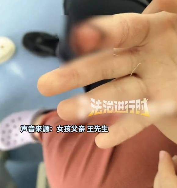 皇冠信用網申请
_北京7岁女童喂马时被咬伤手指指甲断裂皇冠信用網申请
，度假区致歉：先行支付10万元