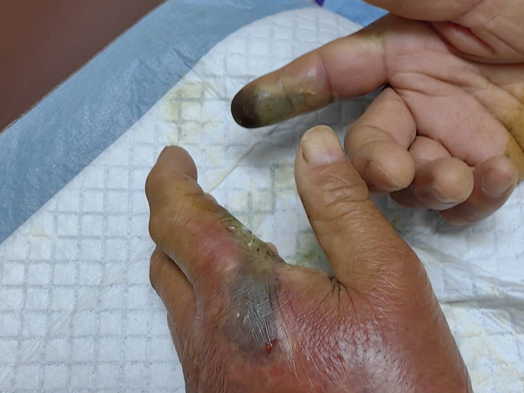 谢周三vs利兹联
_眼镜王蛇咬伤老人谢周三vs利兹联
，家属拖两米多长的“凶手”冲进医院！“拎蛇就医”可取吗？