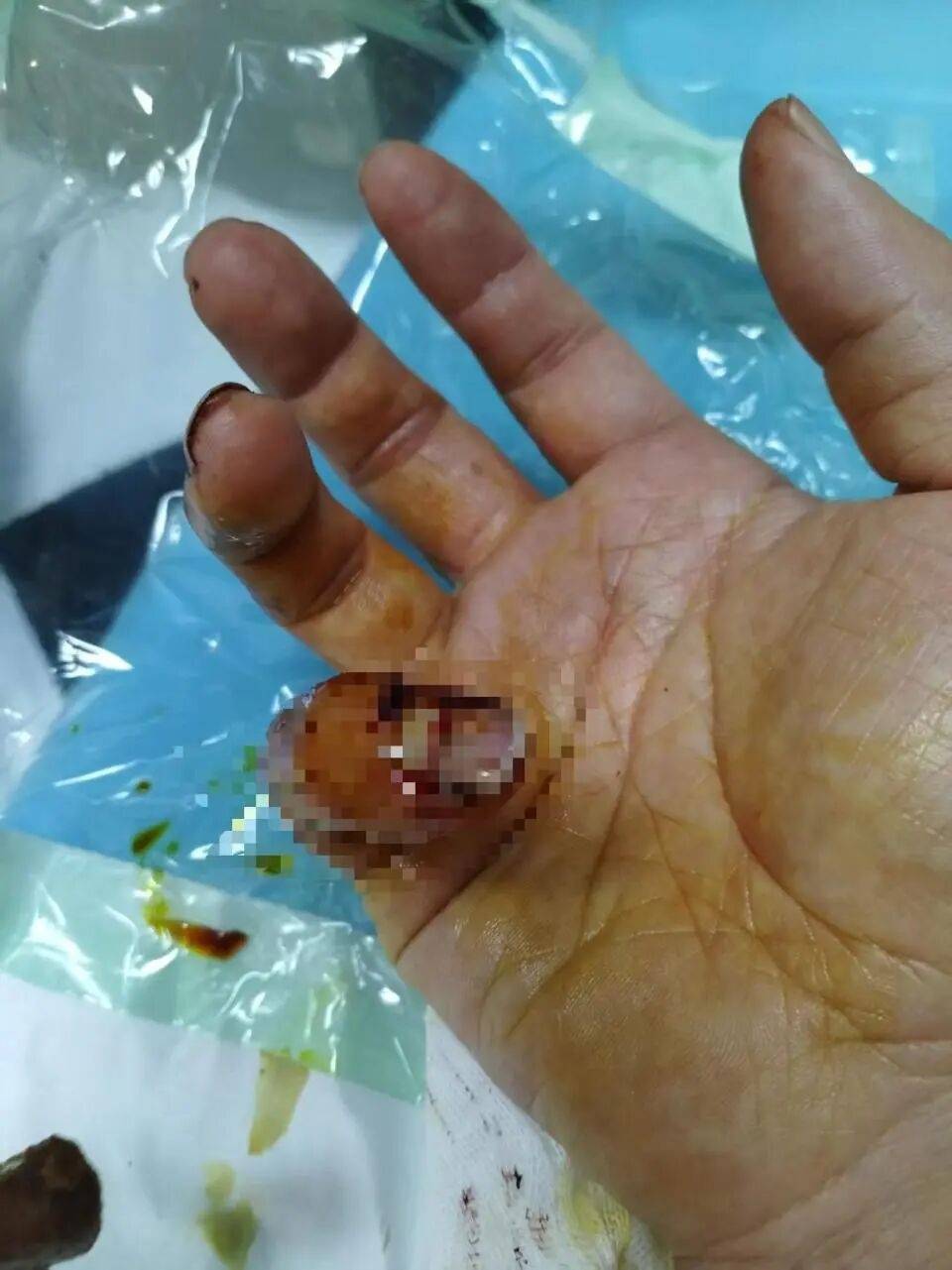 皇冠信用網在线注册_理发店主阻拦城管撕广告被咬伤手指皇冠信用網在线注册，警方：城管误认为商户阻拦行为是殴打，将调查处置