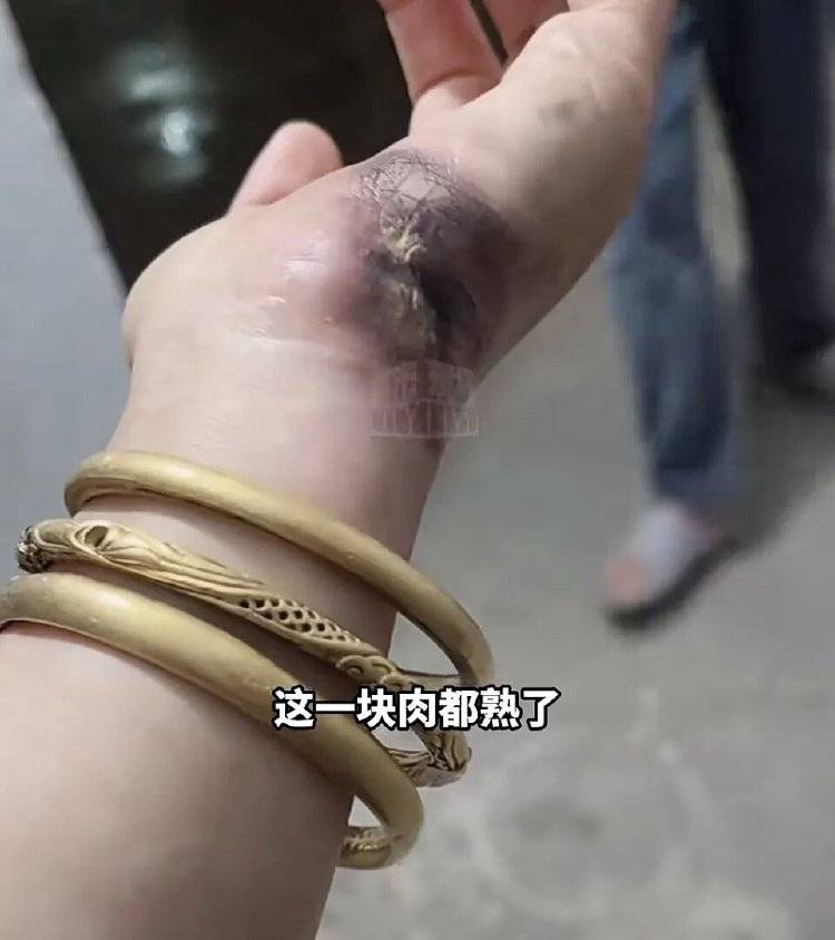 皇冠信用盘庄家
_手被烧熟！金手镯被烧熔！女子给电动车充电皇冠信用盘庄家
，不慎碰到充电口受伤
